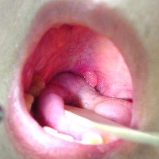 tratamentul papilomelor în gură cum să scoți viermii repede