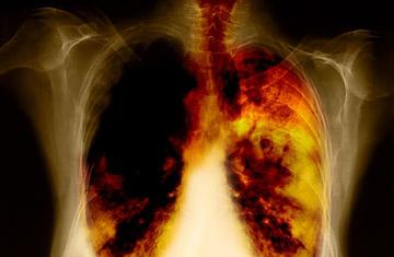 tratamentul cancerului pulmonar cu 4 grade